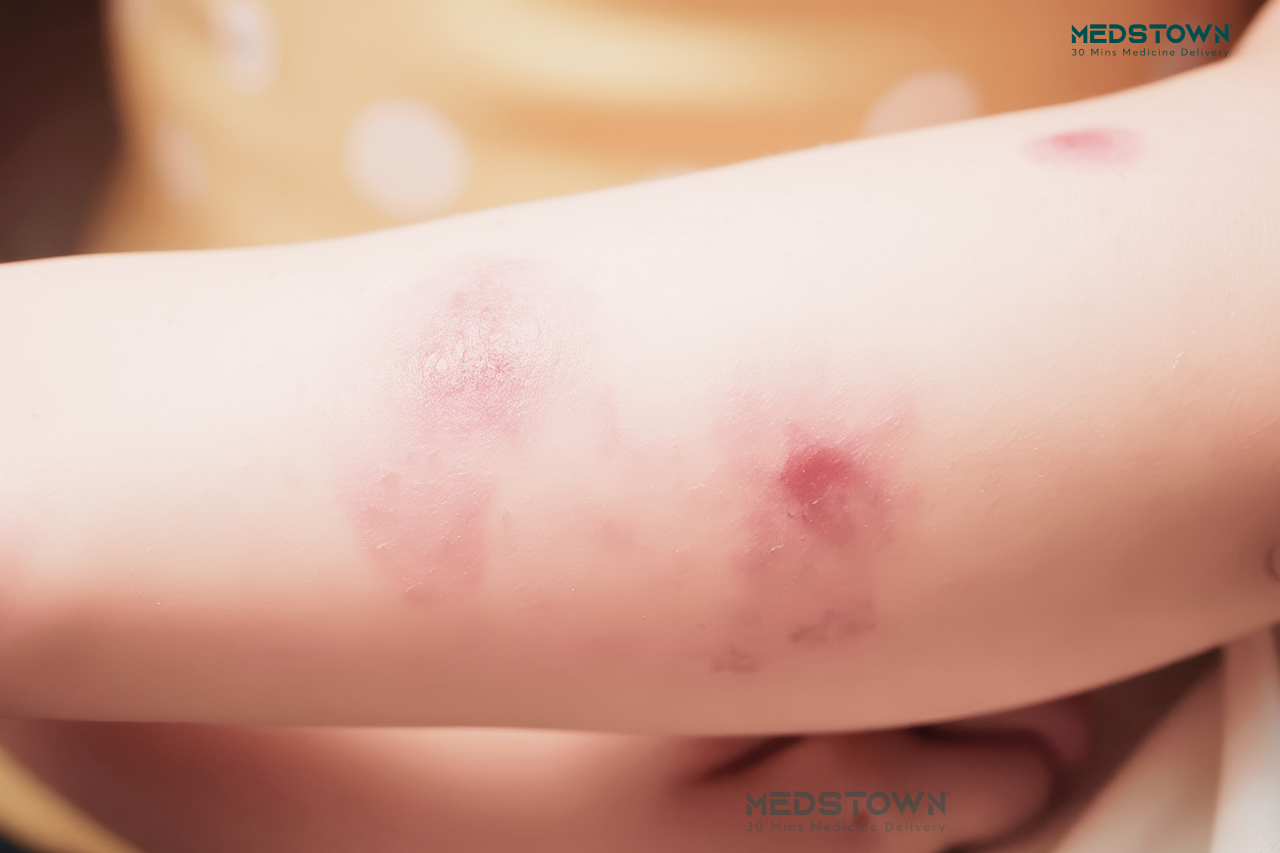 Don’t Ignore That Fever: Melioidosis is The Great Mimicker