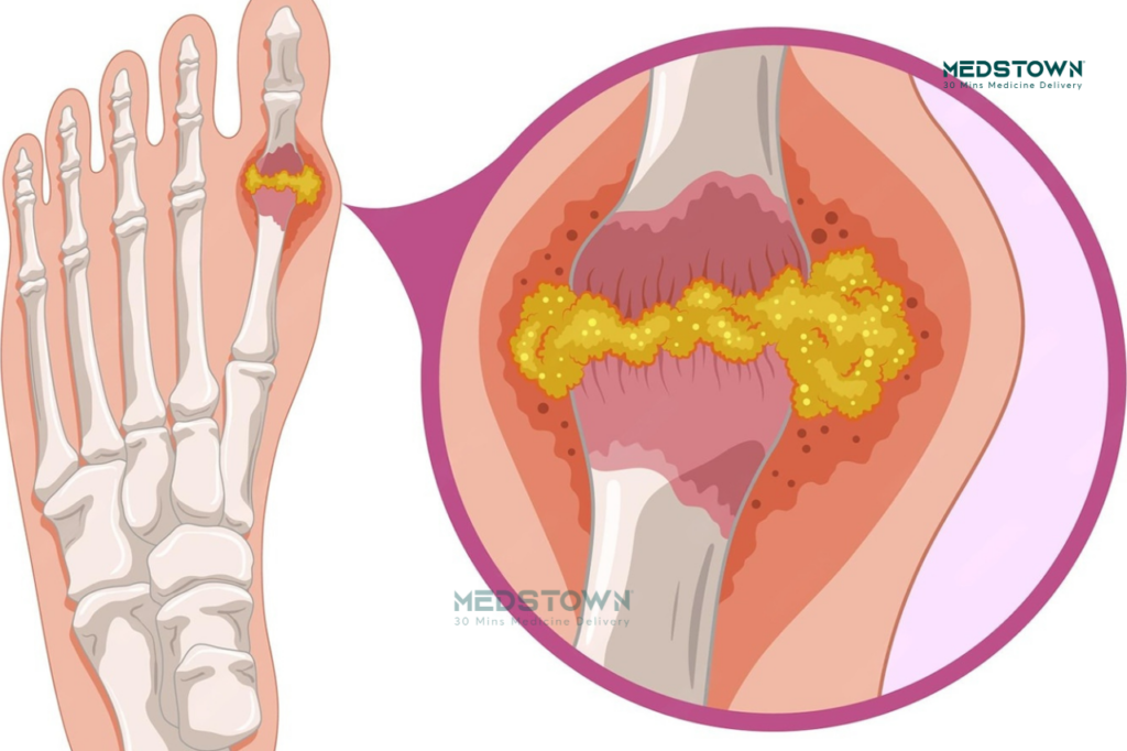 Illustration of joint inflammation and pain