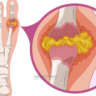 Illustration of joint inflammation and pain