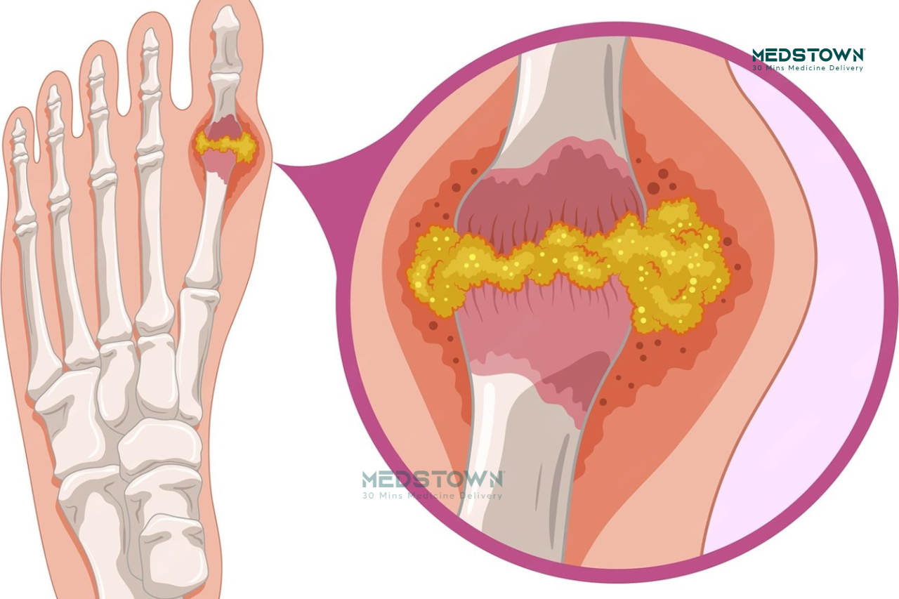 Illustration of joint inflammation and pain