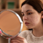 acne face looking into mirror