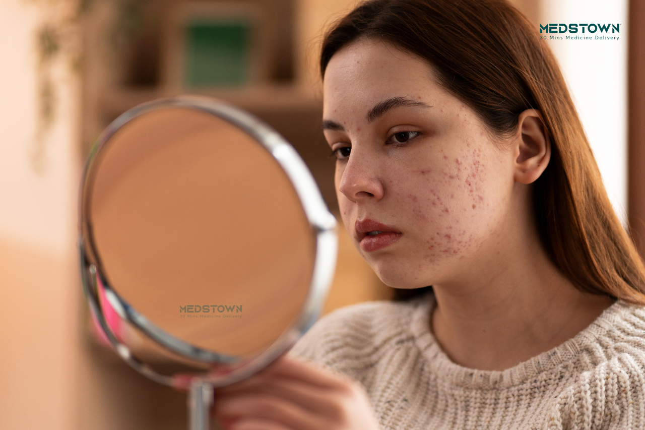Acne Treatment Medicines: What Actually Works & What Doesn’t