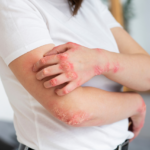 skin allegries and rashes